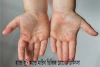 হ্যান্ড ফুট অ্যান্ড মাউথ ডিজিজ রোগের চিকিৎসা - Treatment of hand foot and mouth disease