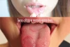 জিহ্বা-ঠোঁটের ঘা সারানোর ঘরোয়া উপায় - Home Remedies for Tongue-lip Sores