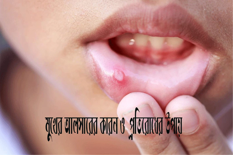 মুখের আলসারের কারন ও  প্রতিরোধের উপায়-Causes and prevention of mouth ulcers
