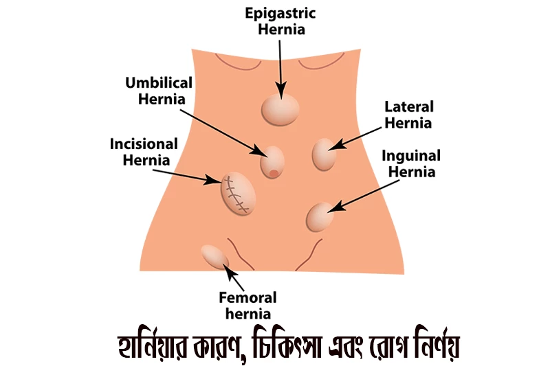 হার্নিয়া: কারণ, চিকিৎসা এবং রোগ নির্ণয়-Hernia: Causes, treatments, and diagnosis